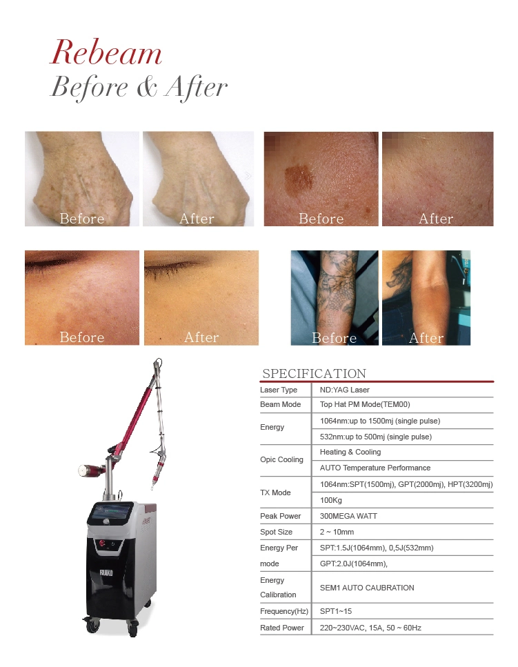 Picosecond Effective and Fast ND YAG Laser Tattoo Removal Machine