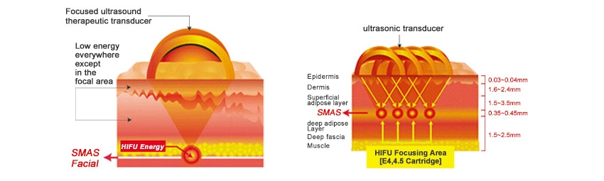 Linuo Ultrasonido 3 in 1 Intensity Focused Ultrasound Hifu Anti-Wrinkle Skin Tightening Machine Hifu Face Lift Device