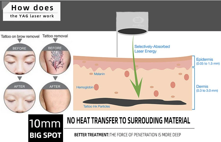 Big Promotion Price Picosure Q-Switch ND YAG Laser Tattoo Removal Freckle Removal Laser Machine