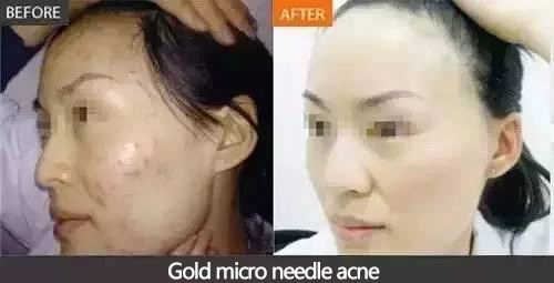 Professional Microneedling Fractional RF Acne Treatment Skin Rejuvenation Scar Removal Machine