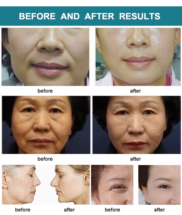 Korea V-Max Ultrasound Face Lift Machine Skin Lifting Home Use Hifu Beauty Device