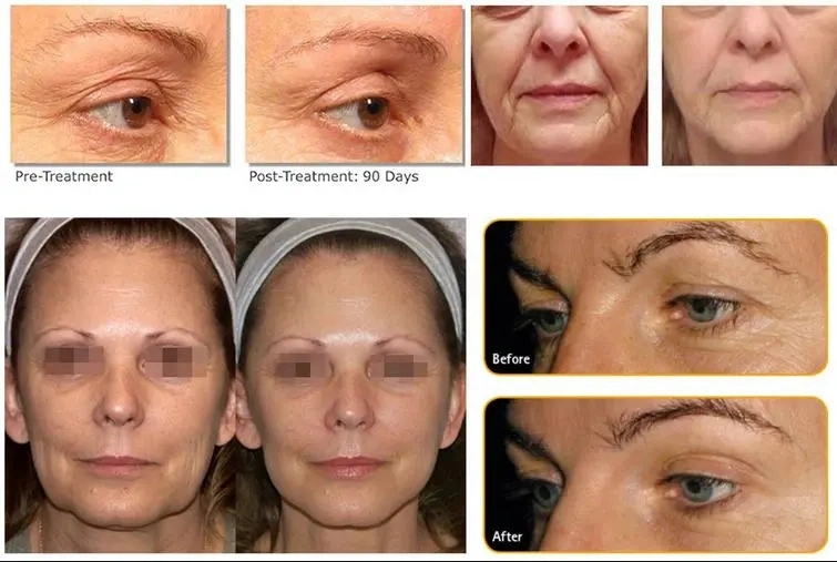 Ultrasound Anti-Aging Wrinkle Removal Face Lifting Hifu Beauty Machine