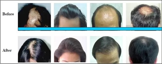 Beauty Salon Equipment 650nm Laser Diode Machine Hair Regrowth Anti Hair Loss Treatment Equipment