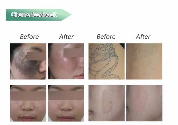 Picosecond Tattoo Removal Laser for Skin Clinic