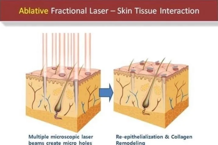 New Arrival CO2 Fractional Laser Skin Resurfacing