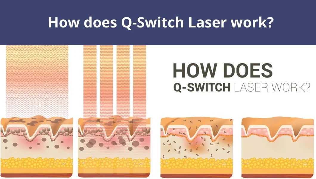 Laser Clinic Use Portable Q-Switch ND YAG Laser