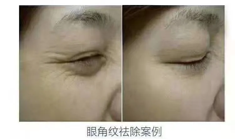 Portable Ultrasonic Hifu Anti-Wrinkle Anti-Aging Facelift Wrinkle Remover Beauty Machine