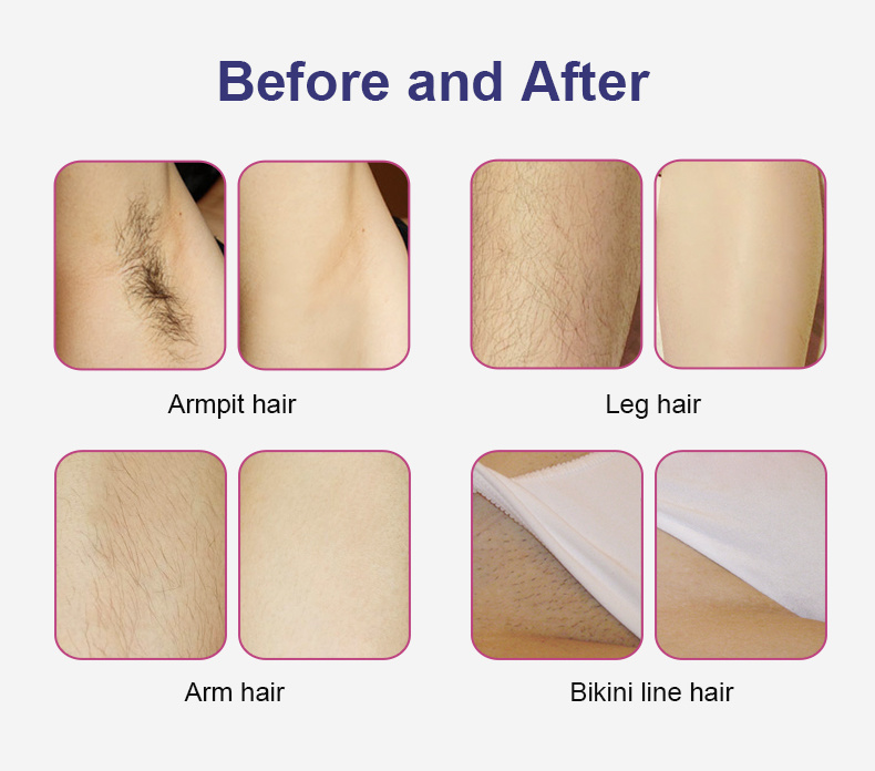 Newest Diode Laser Hair Removal Machine for Beauty SPA Body Hair Diode Laser Hair Removal