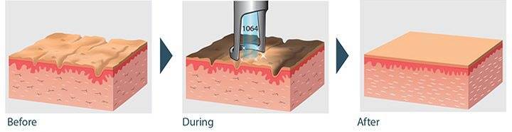 ND YAG Laser Price Carbon Peel Q Switched ND YAG Laser 1064 532 755nm