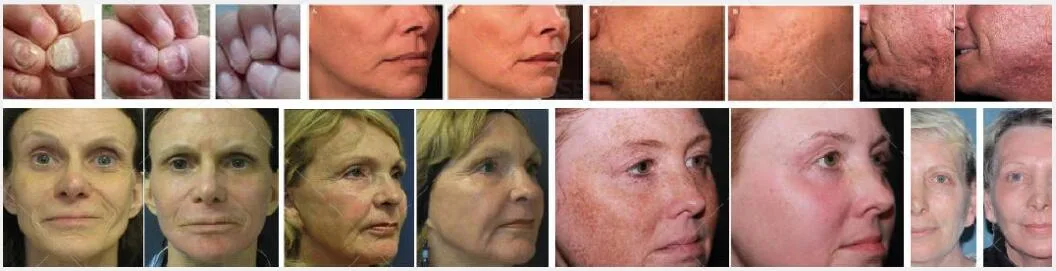 Best Effective Wrinkle Remove and Skin Care CO2 +RF Fractional Laser CO2 Fractional Medical Laser