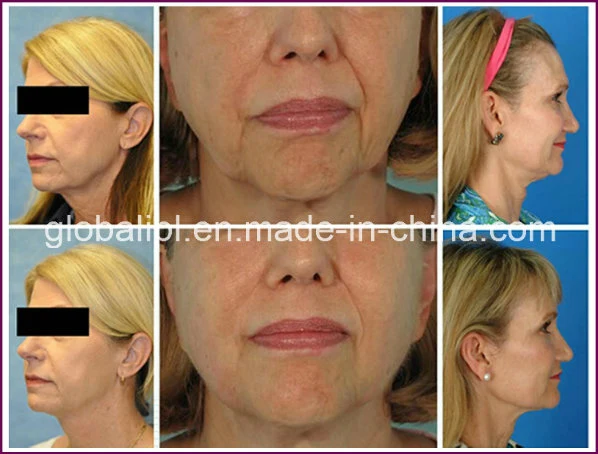 High Intensity Shaping Wrinkle Contouring Face Hifu Facial Lifting Fat Removal Ultrasound Hifu Machine