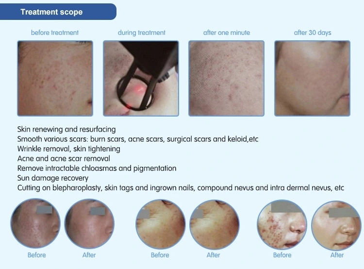 Rosacea and Various Scars Treatment Women Vagina Tightening Fractional CO2 Laser Scanning Machine CO2 Fractional Clinic