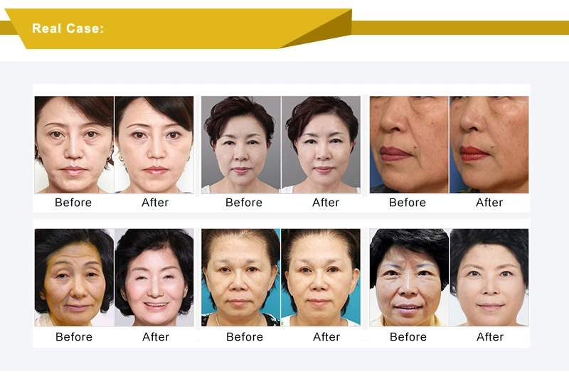 Skin Tightening Hifu for Wrinkle Removal System Skin Tightening Machine Face Lift