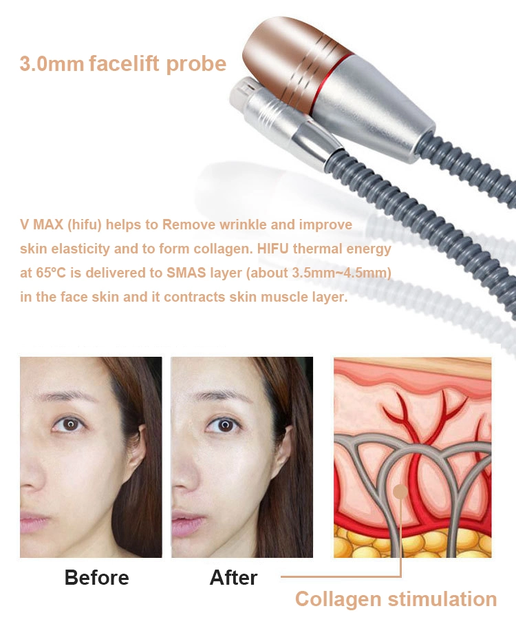 Hifu Ultrasound Vmax Face Lifting 2 in 1 Mini Hi Fu Cartridge Vaginal Tightening Hifu Anti-Wrinkle Machine