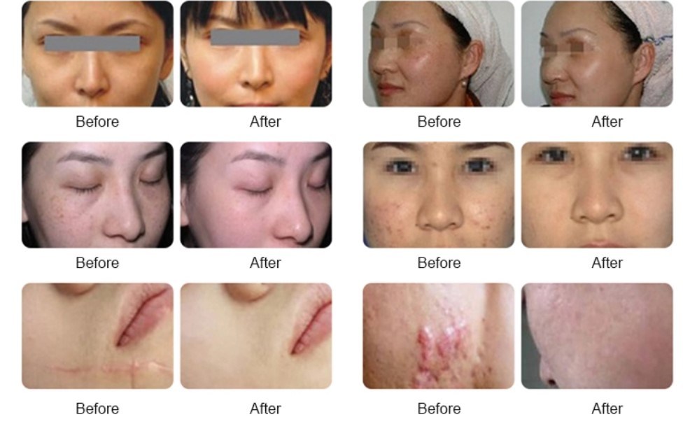 Skin Resurfacing Acne Scar Treatment Laser Equipment CO2 Fractional