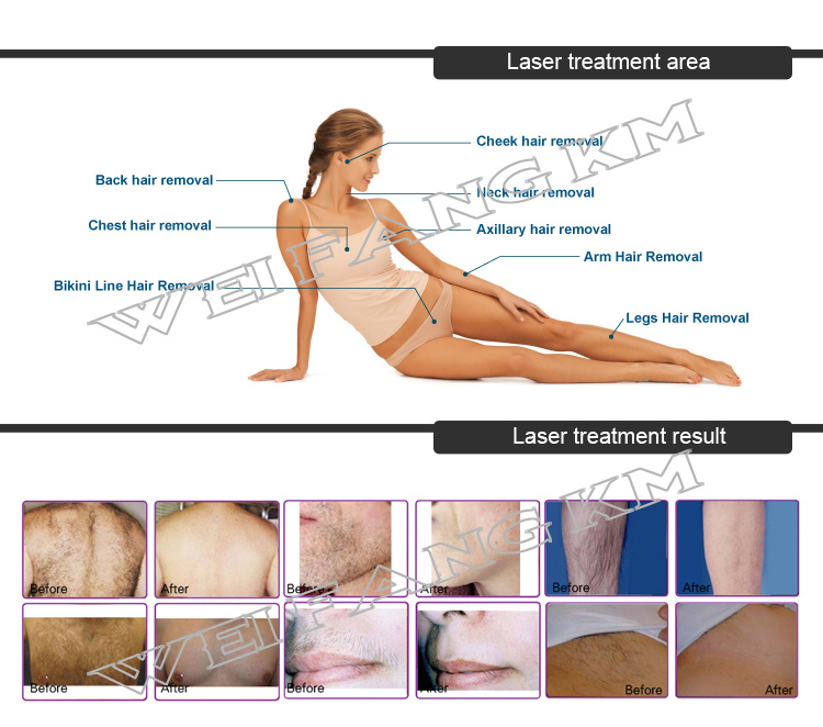 High Quality IPL Diode Laser Hair Removal Machine Price