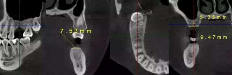Hires 3D-Max Dental Panoramic Imaging Cbct Scanner Dental Xray Scan