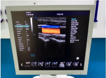 Ultrasound Scanner Doppler Ultrasound Scanner Manufacturer Trolley Ultrasound Scanner