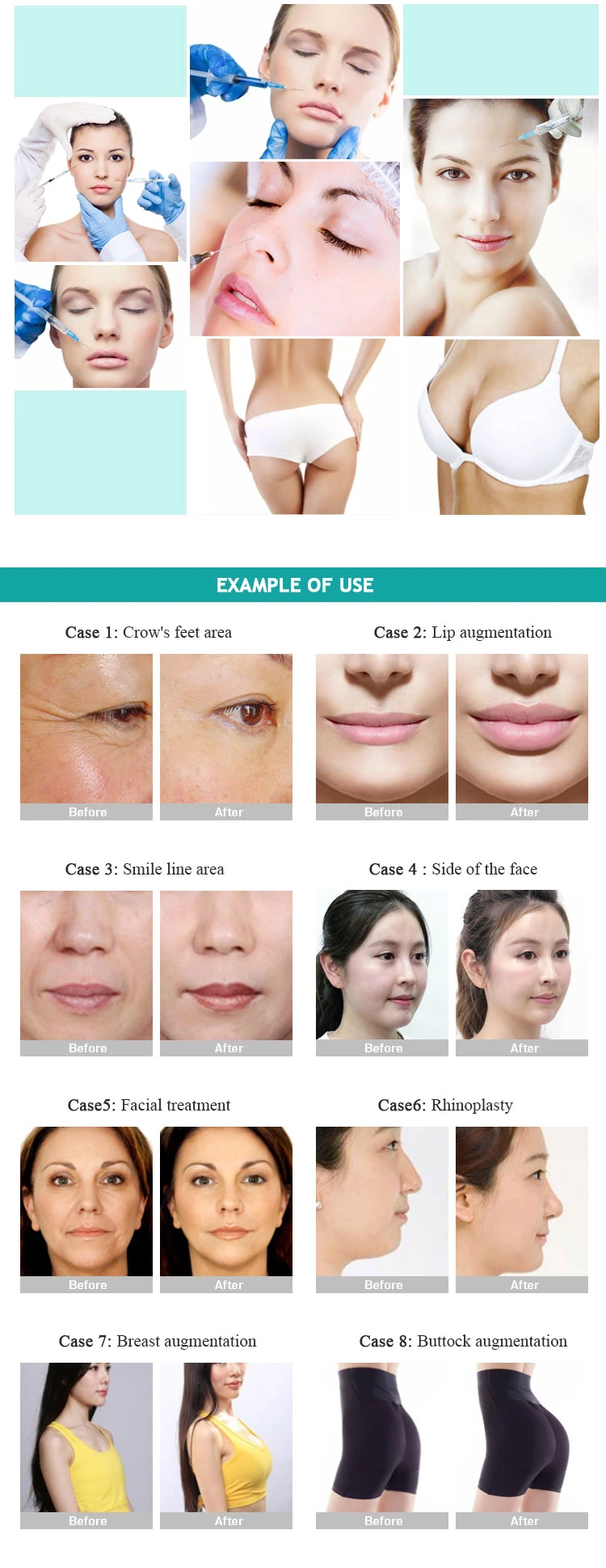 10ml Korea Ultra Deep Dermal Filler/High Quality Cross Linked Dermal Filler /Breast Enhancement Dermal Filler