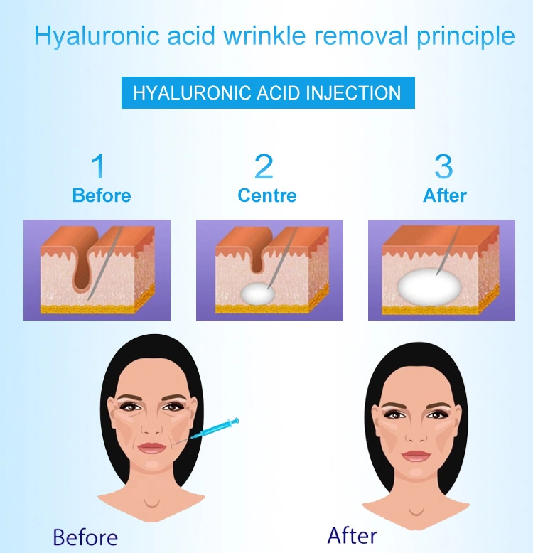 Filler Hyaluronic Acid Injection Hyaluronic Acid Lip Filler Hyaluronic Acid Injections Filler