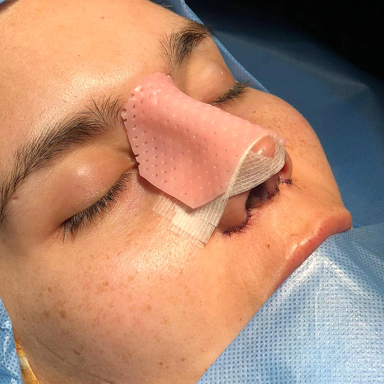 Thermoplastic Nasal Splint for Rhinoplasty Use Thermoplastic Sheet with CE ISO