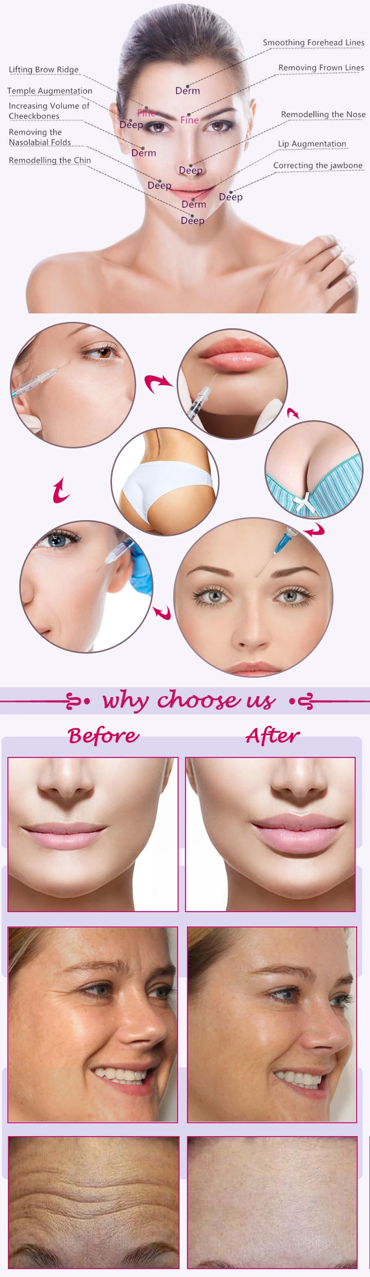 America 1ml 2ml Anti Wrinkle Benefits of Hyaluronic Acid for Skin Lip Injections