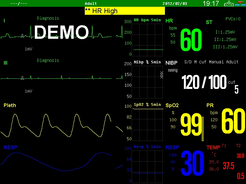 15inch Portable Patient Monitor with Touch Screen (SNP9000I) Bedside ECG Monitor/5parameter