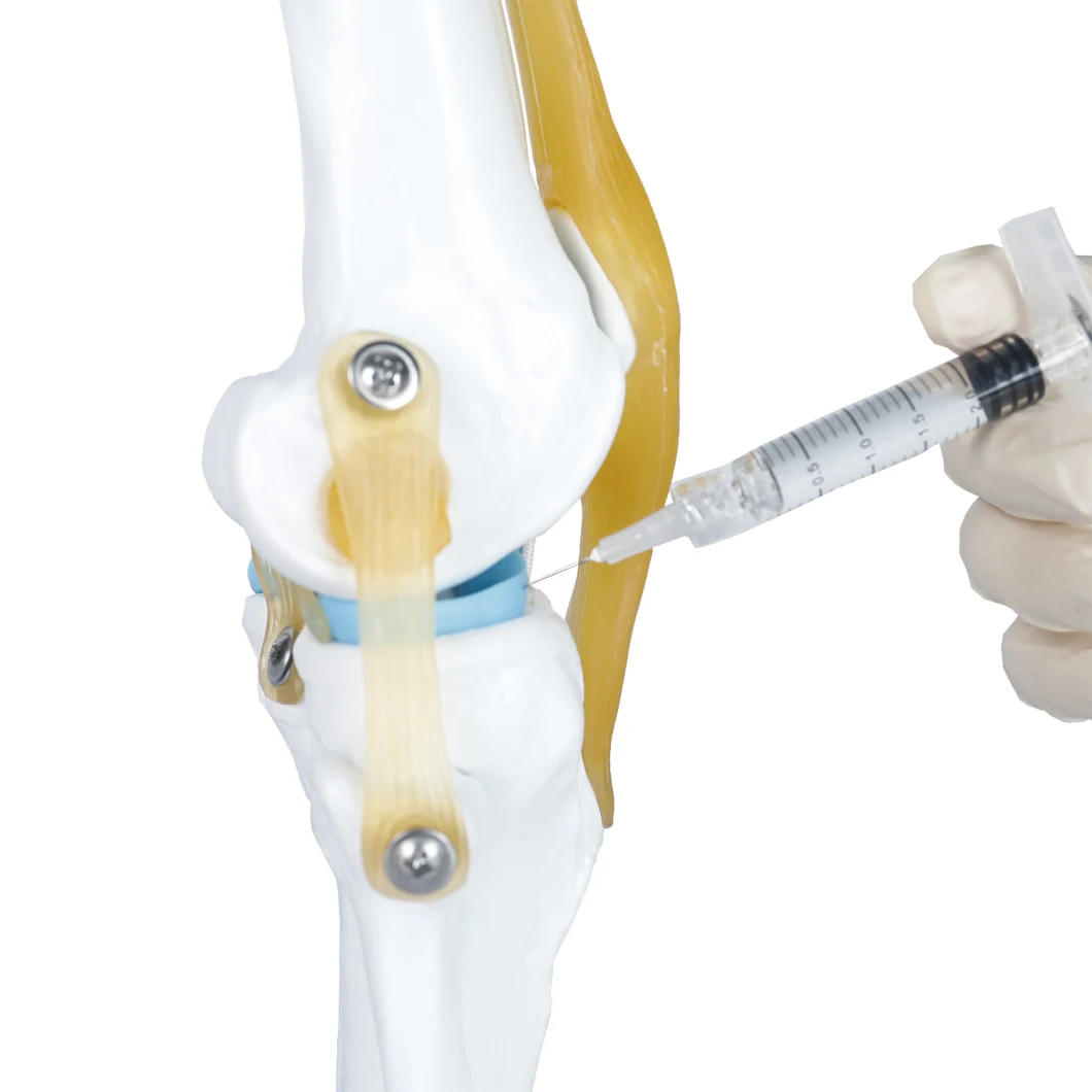 Osteoarthritis Knee Injection Intra-Articular Injection Hyaluronic Acid Knee