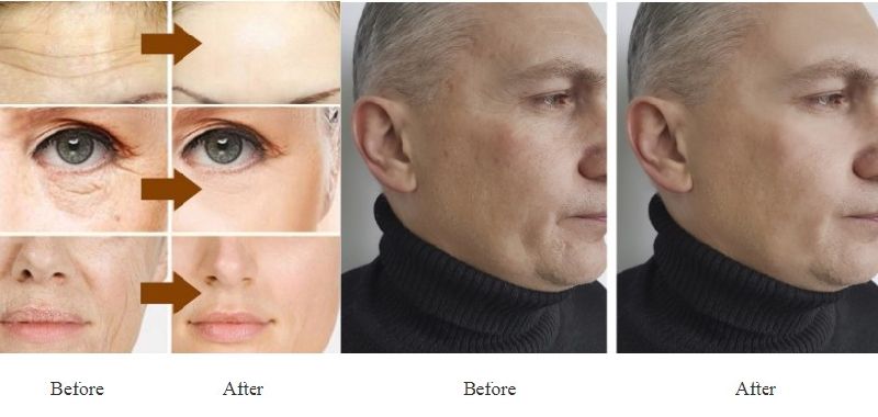 Deep Wrinkle Filler Injection Dermal Filler for Facial Deep 2ml