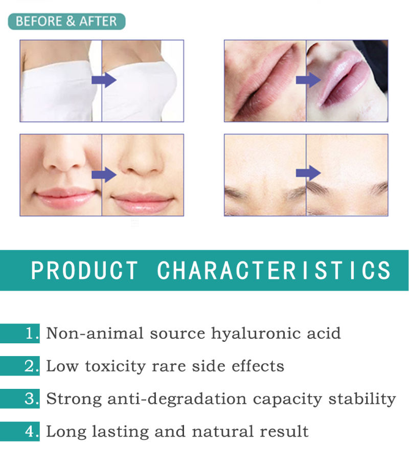 Dermal Filler Deep Acid Hyaluronic Injection Dermal Filler for Deep Wrinkles