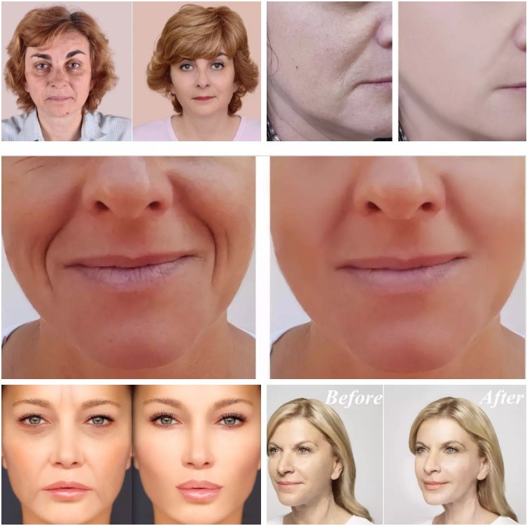 Deep Wrinkle Filler Injection Dermal Filler for Facial Deep 2ml