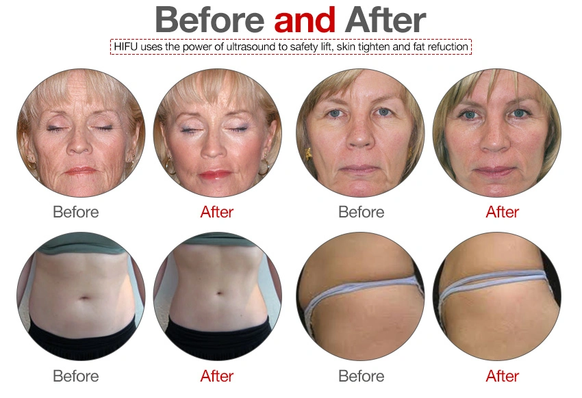 Effective Treatment Result 3D Hifu Face and Body Equipment for Face Life /Body Slimming