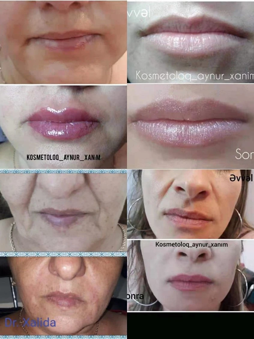 Anti Wrinkle Hyaluronic Acid Dermal Filler for Lip, Cheek, Breast, Lip Filler
