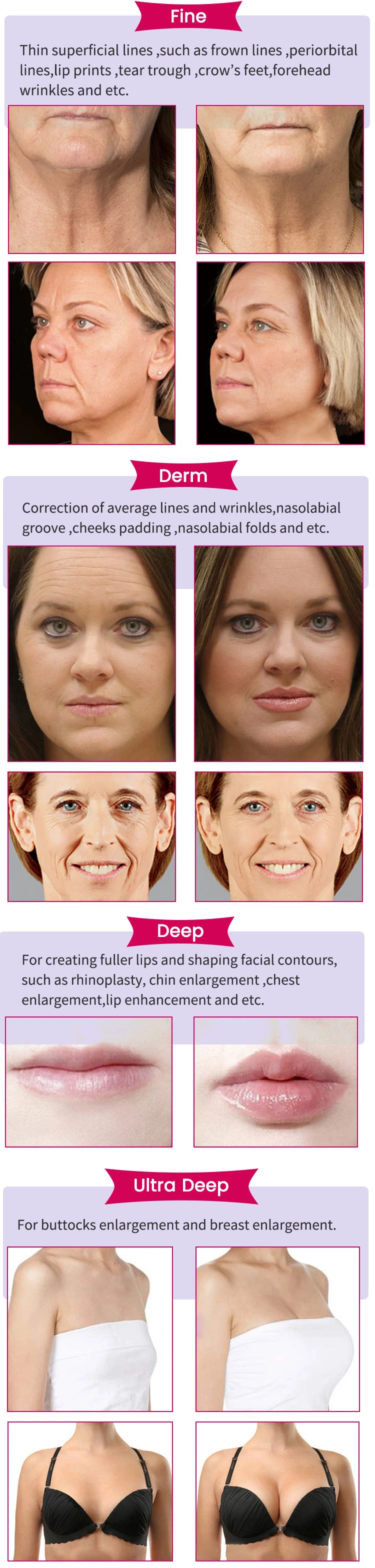 Eyebrow Enhancer Facial Cross Linked Sodium Hyaluronic Acid Dermal Filler 5ml