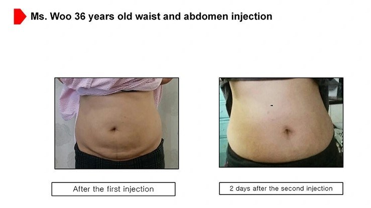 The Red Solution Slimming Fat Dissolving Lipolytic The Red Injection