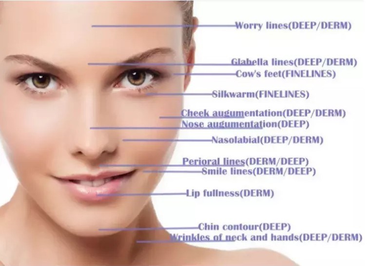 Skinject Hyaluronic Acid Ingredients Facial Dermal Fillers