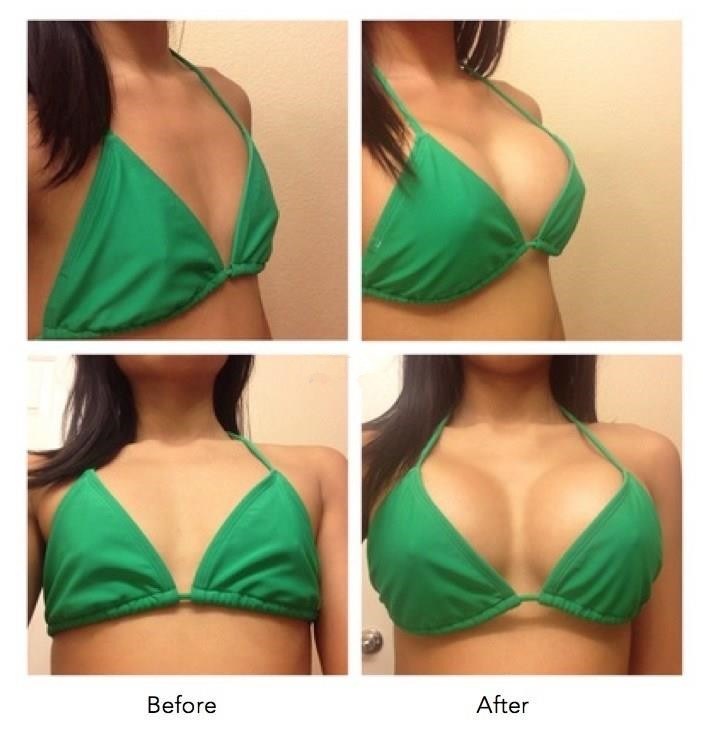 Clinic Used Hyaluronic Acid Injection for Buttocks and Breast Acid Hyaluronate Dermal Filler