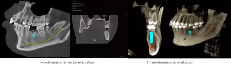Hires 3D Digital Large Fov Dental Cbct with Cephalometric Measurement Oral Surgery Evaluation High-Accurate Image