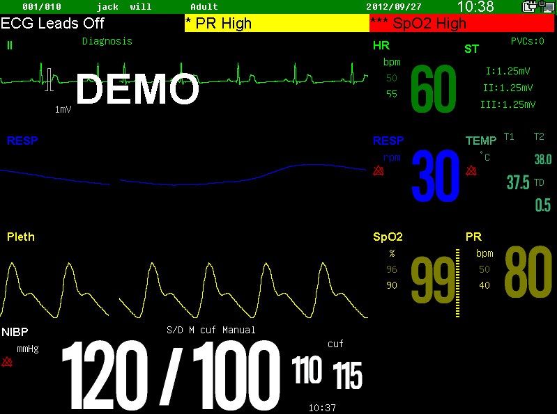 Sinnor Snp9000W Handheld 15 Inch Etco2 and SpO2 Patient Monitor/Portable Capnograph Patient Monitor