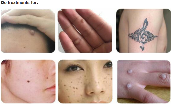 Plasma Pen Tattoo Mole Spot Removal