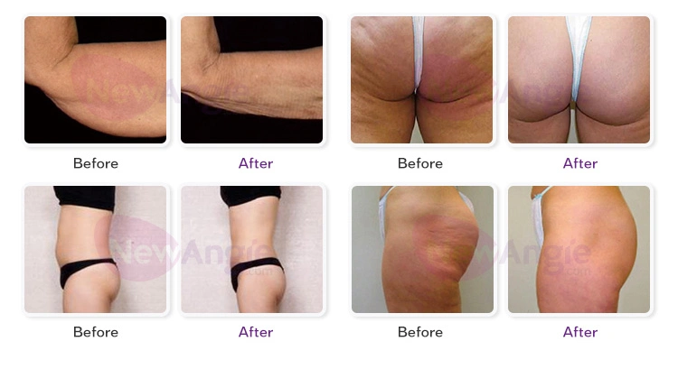 Abdomen Thigh Fat Removal Butt Lifting Anti Cellulite Massage RF Cavitation Vacuum Roller Slimming Equipment