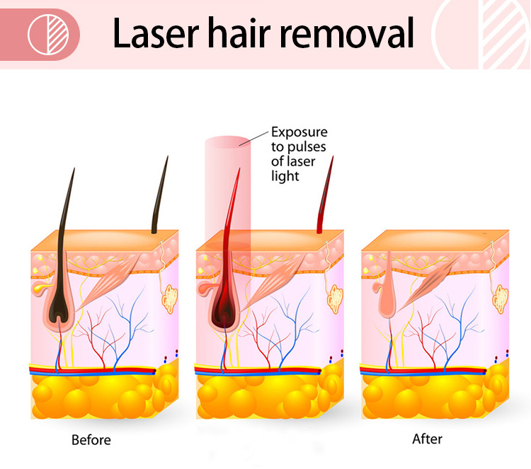 High Power Diode Laser Machines Epicare Hair Removal Alexandrite Laser