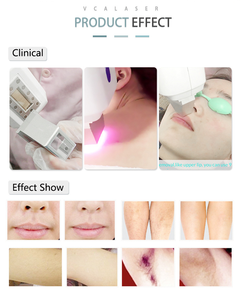 Amazing Result Semiconductor Portable 808nm Diode Laser Hair Removal