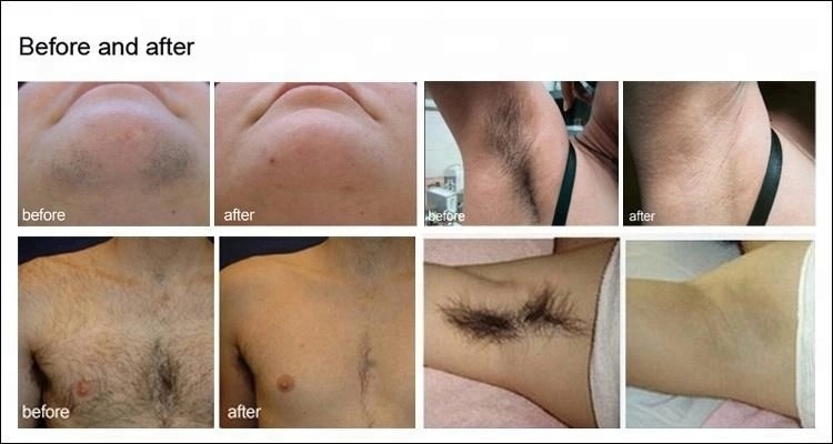 100% Best Results Hair Removal Diode Laser From Globalipl