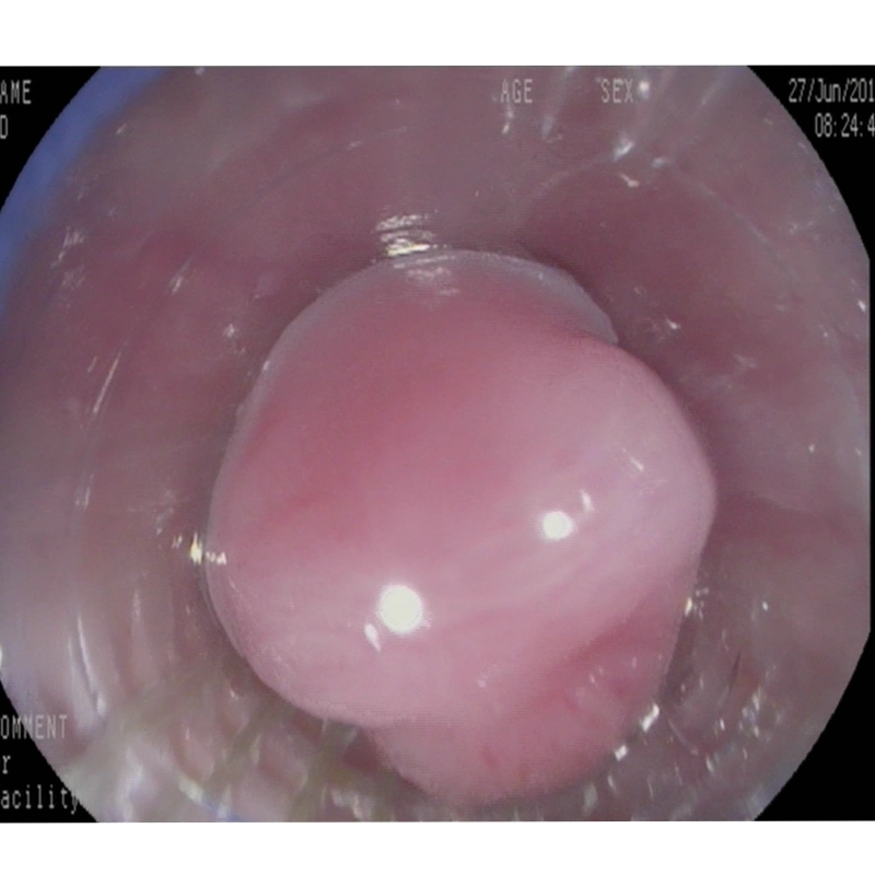 6 Shooter Multi-Band Ligator Used to Endoscopically Ligate Esophageal Varices