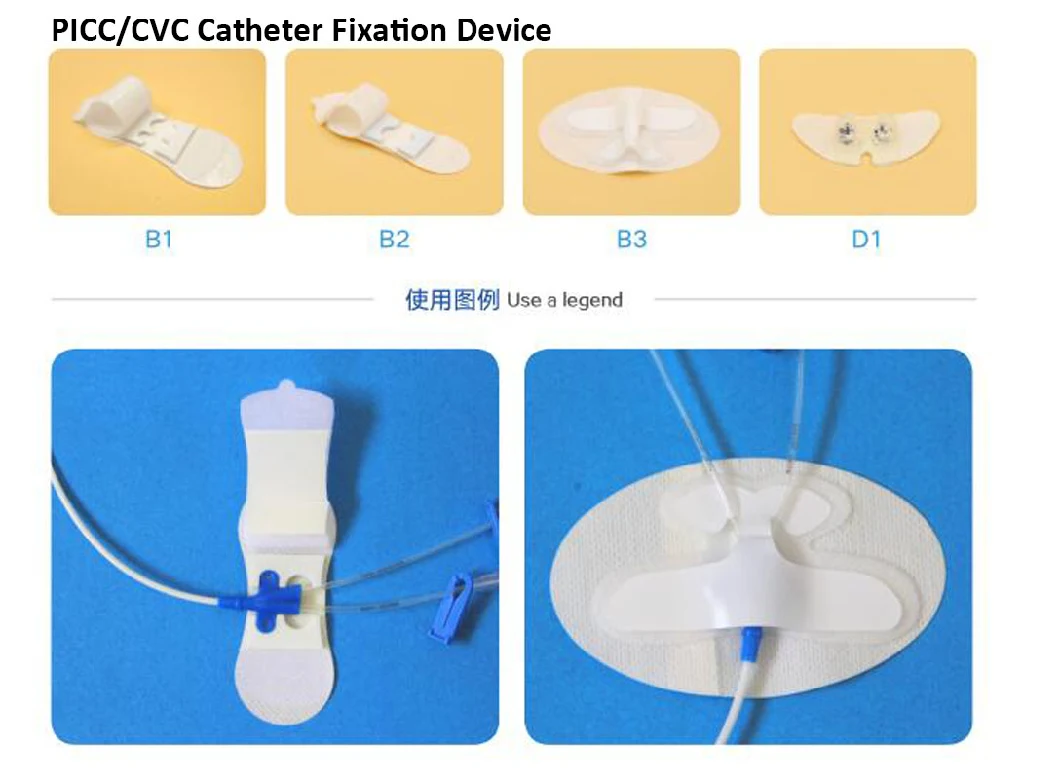 Medical Catheter Fixation Device for Hospital Clinic Pharmacies