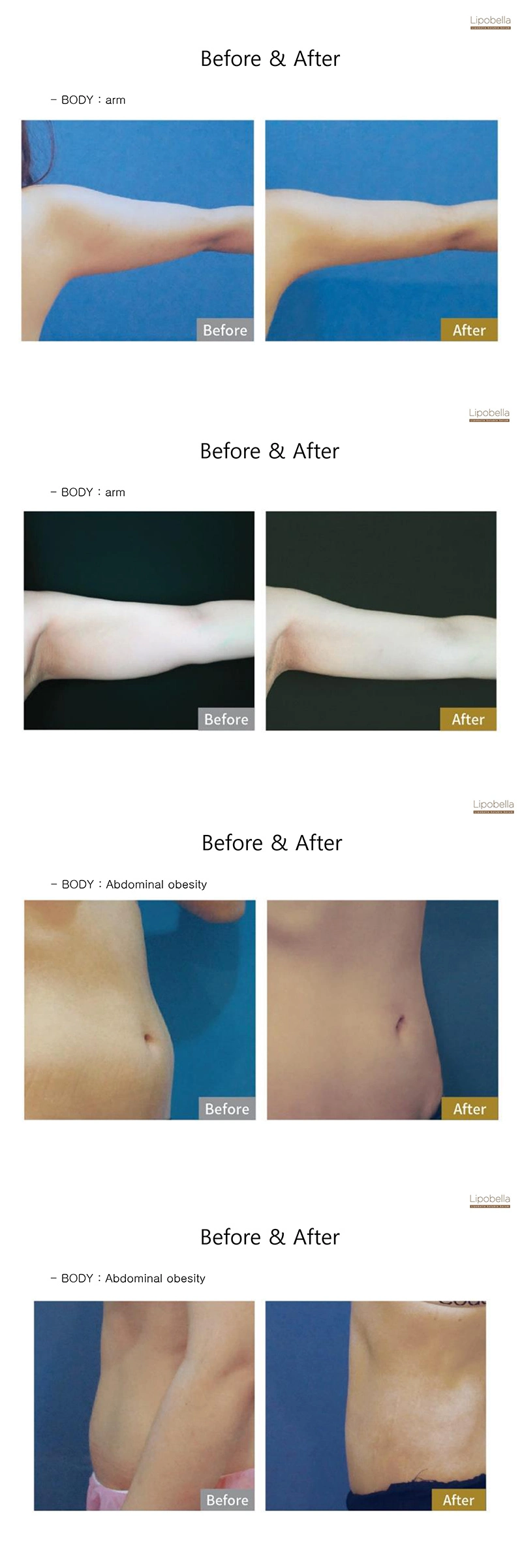 Korea Lipolysis Slimming Solution Injection for Melting Subcutaneous Fat