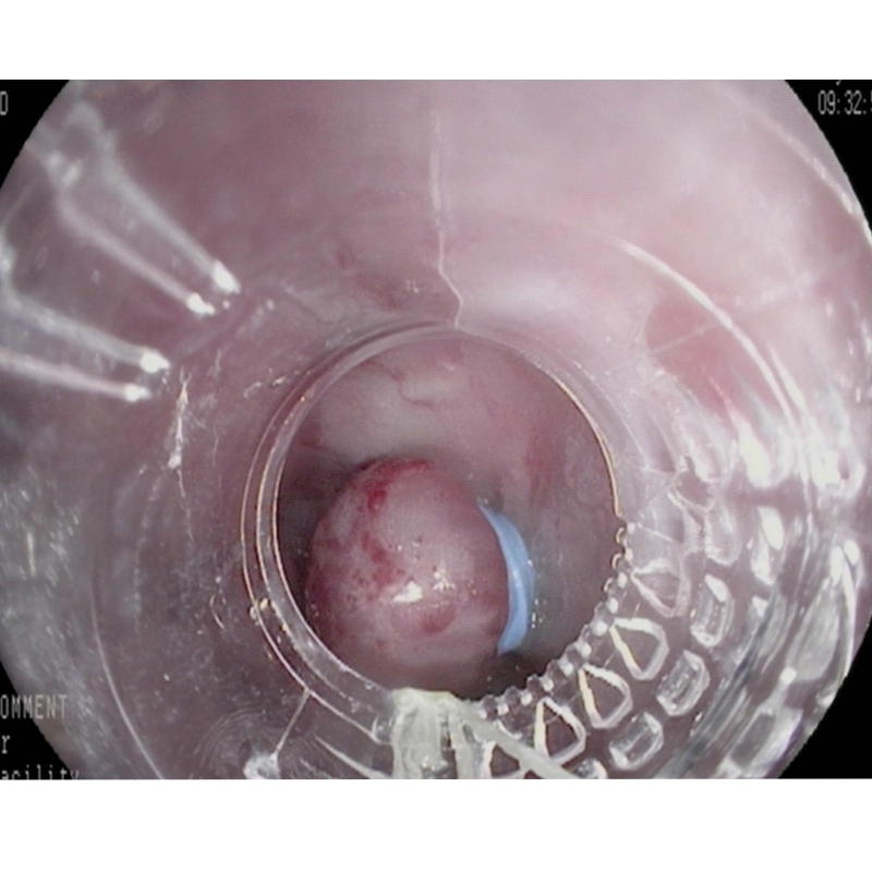 Endoscopic Multi-Band Ligator for Esophageal Varices of Medical Instruments