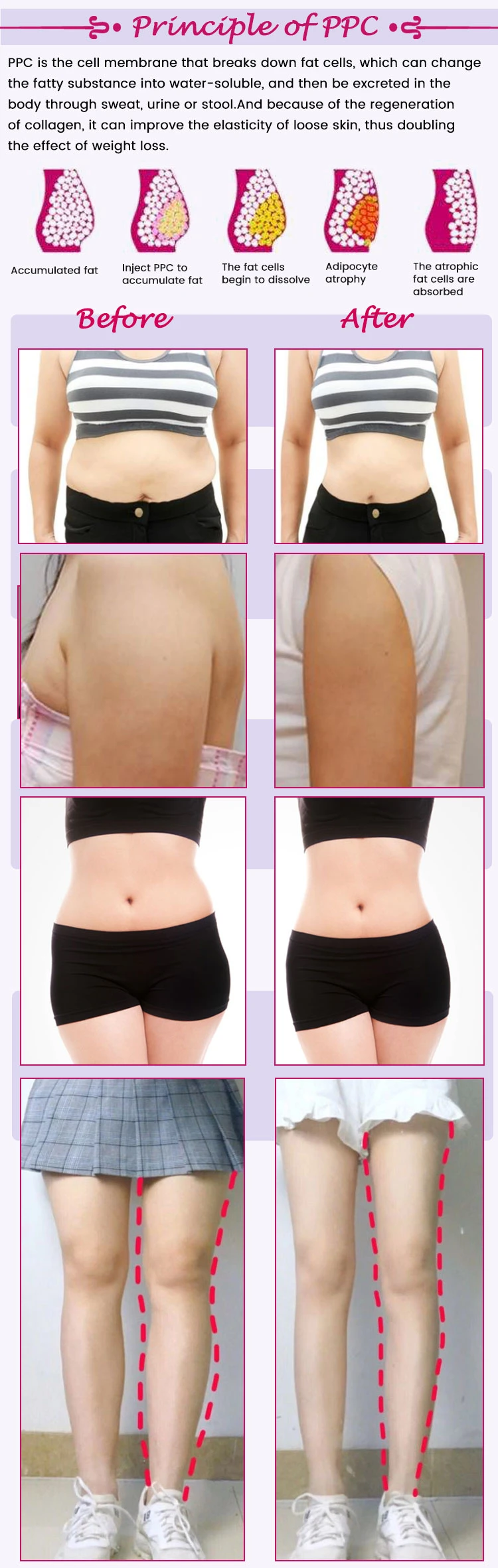 Korea Plant Extracts Lipolysis Slimming Solution Injection for Melting Subcutaneous Fat