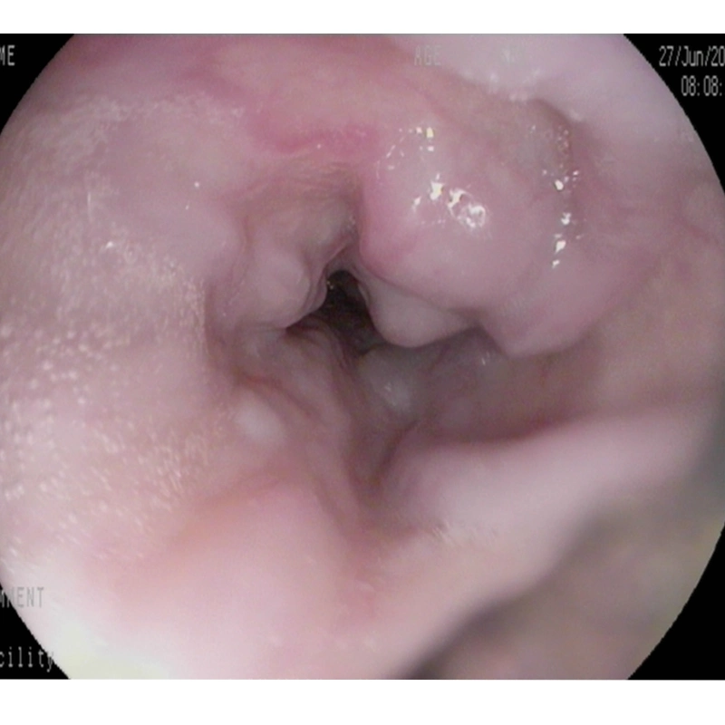 Endoscopic Multi-Band Ligator for Esophageal Varices of Medical Instruments